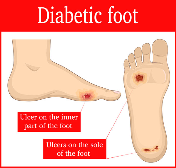 What does a diabetic foot look like?